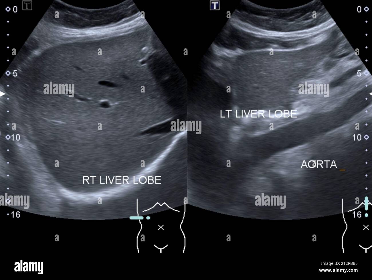 Healthy liver, ultrasound scan Stock Photo Alamy