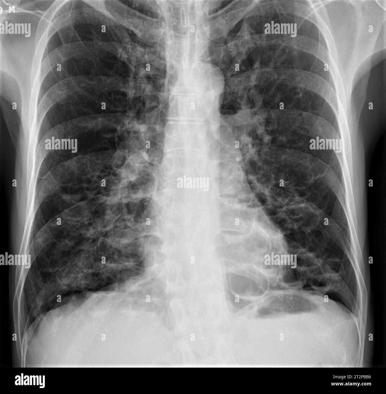 Bronchiectasis, X-ray Stock Photo
