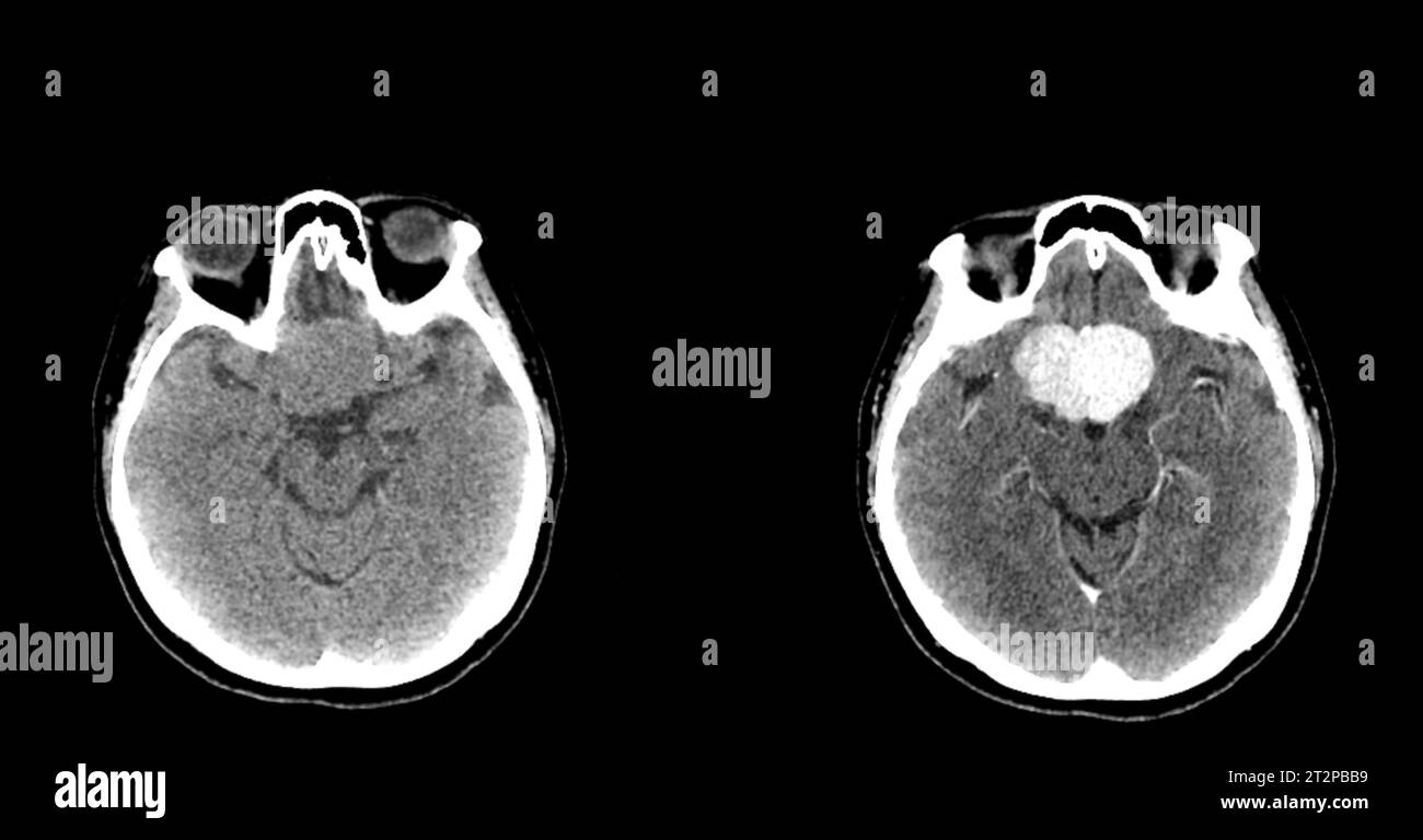 Computed tomography (CT) scan of the head of a 39 year old female