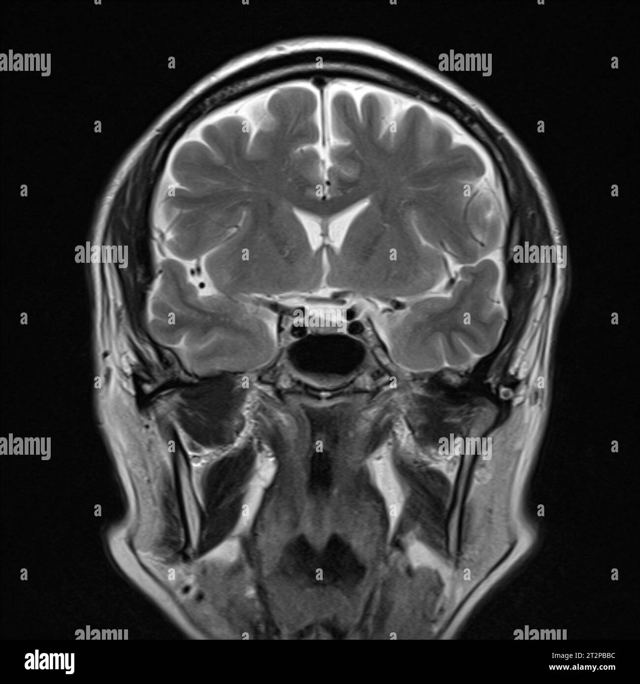 Healthy brain, MRI scan Stock Photo - Alamy