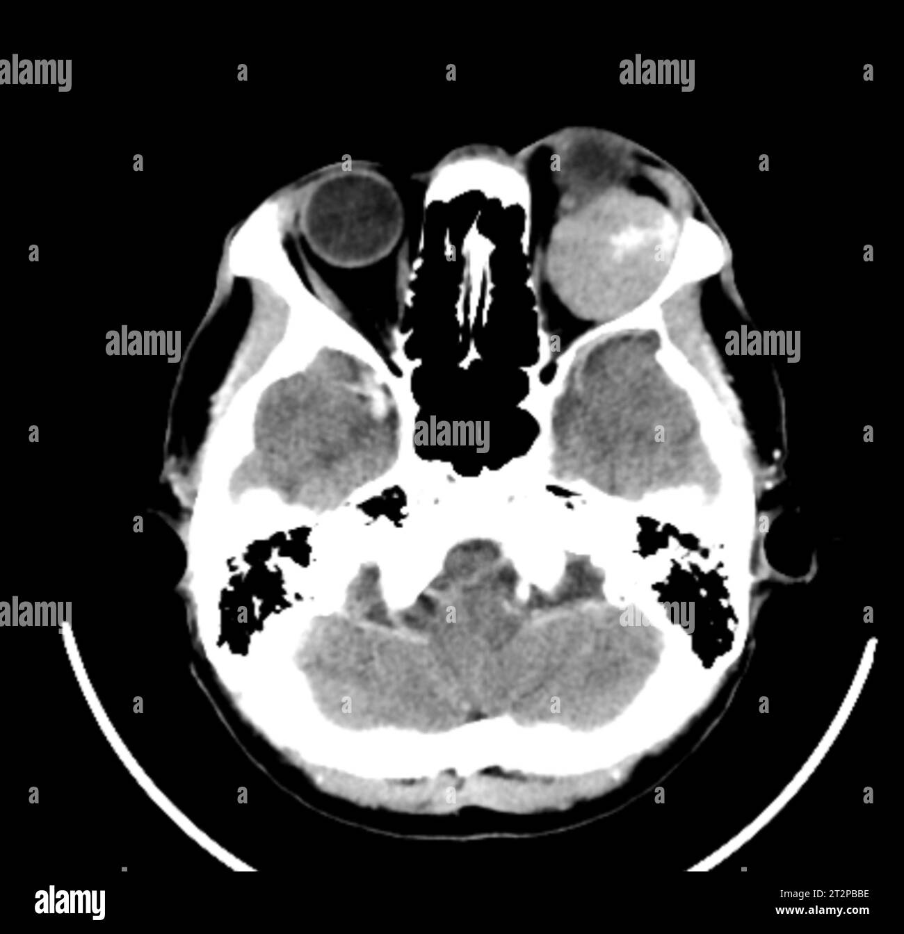 Orbital tumour, CT scan Stock Photo