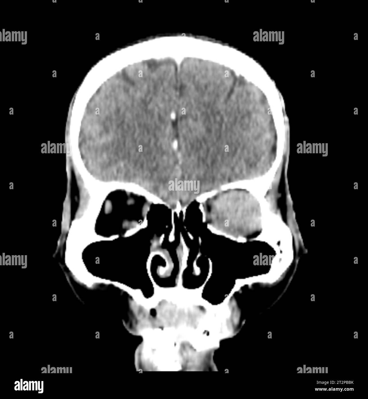 Orbital tumour, CT scan Stock Photo