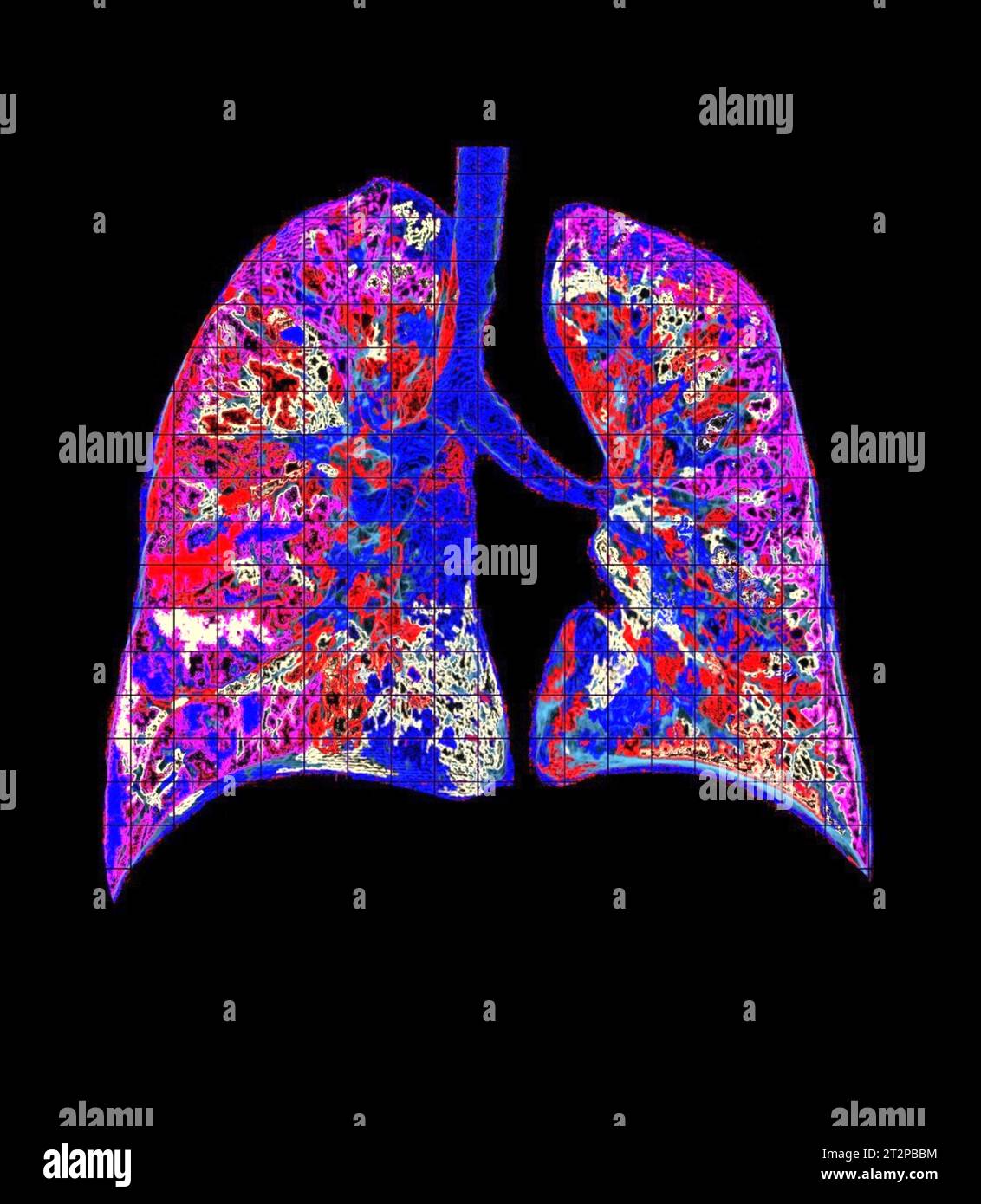 Healthy lungs, CT scan Stock Photo Alamy