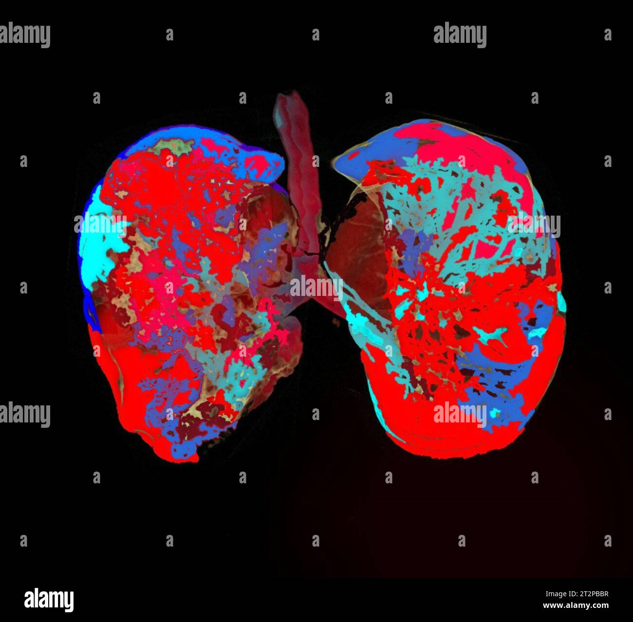 Healthy lungs, CT scan Stock Photo