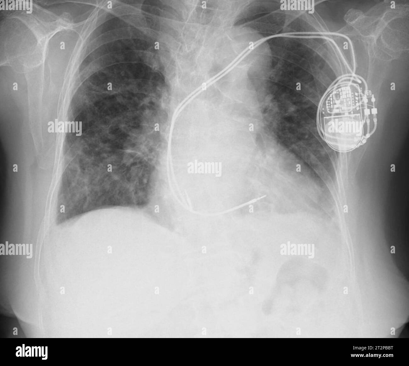 Pacemaker, X-ray Stock Photo