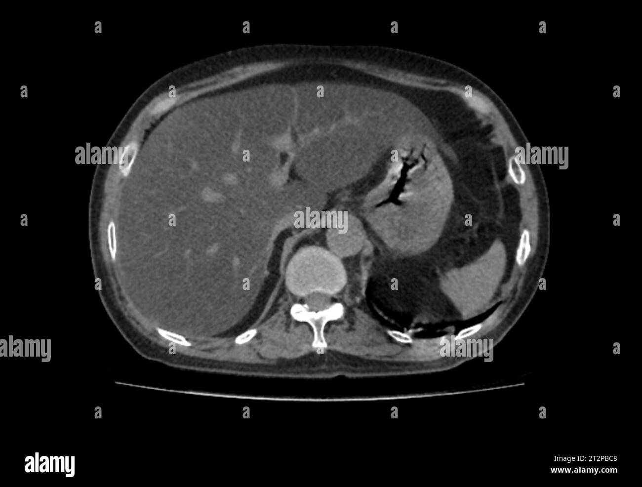 Fatty liver, CT scan Stock Photo