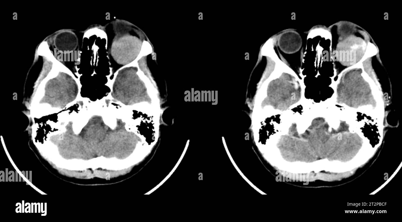 Orbital tumour, CT scan Stock Photo