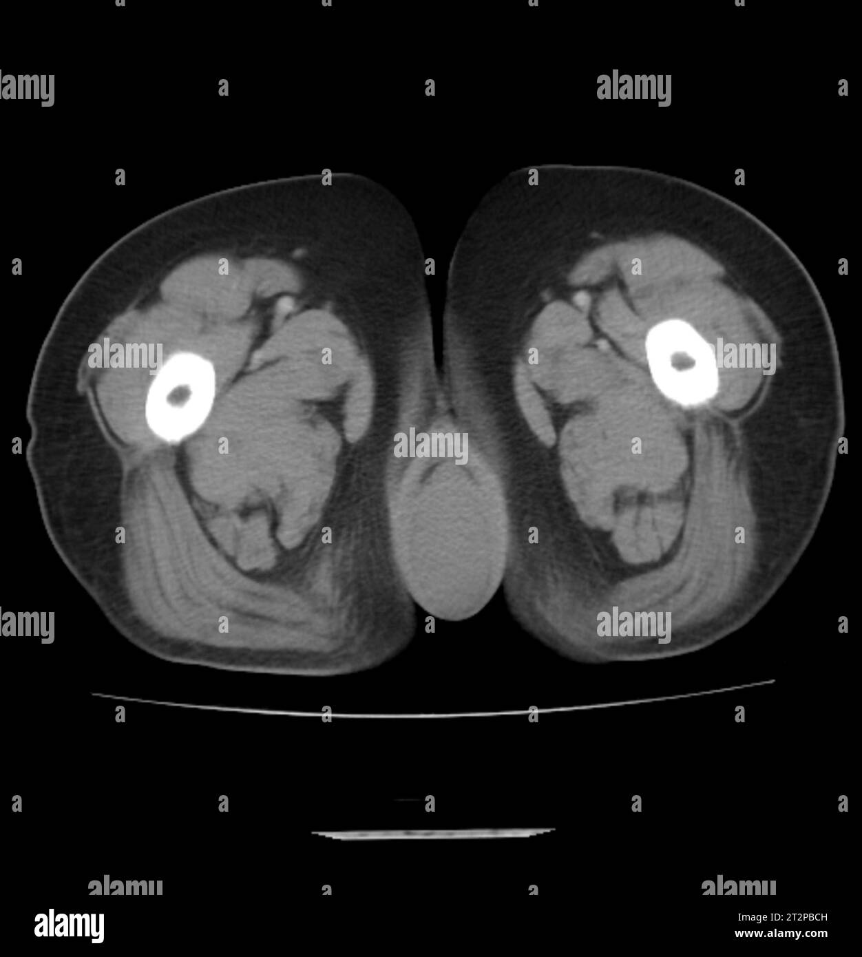 Prolapsed uterus, CT scan Stock Photo