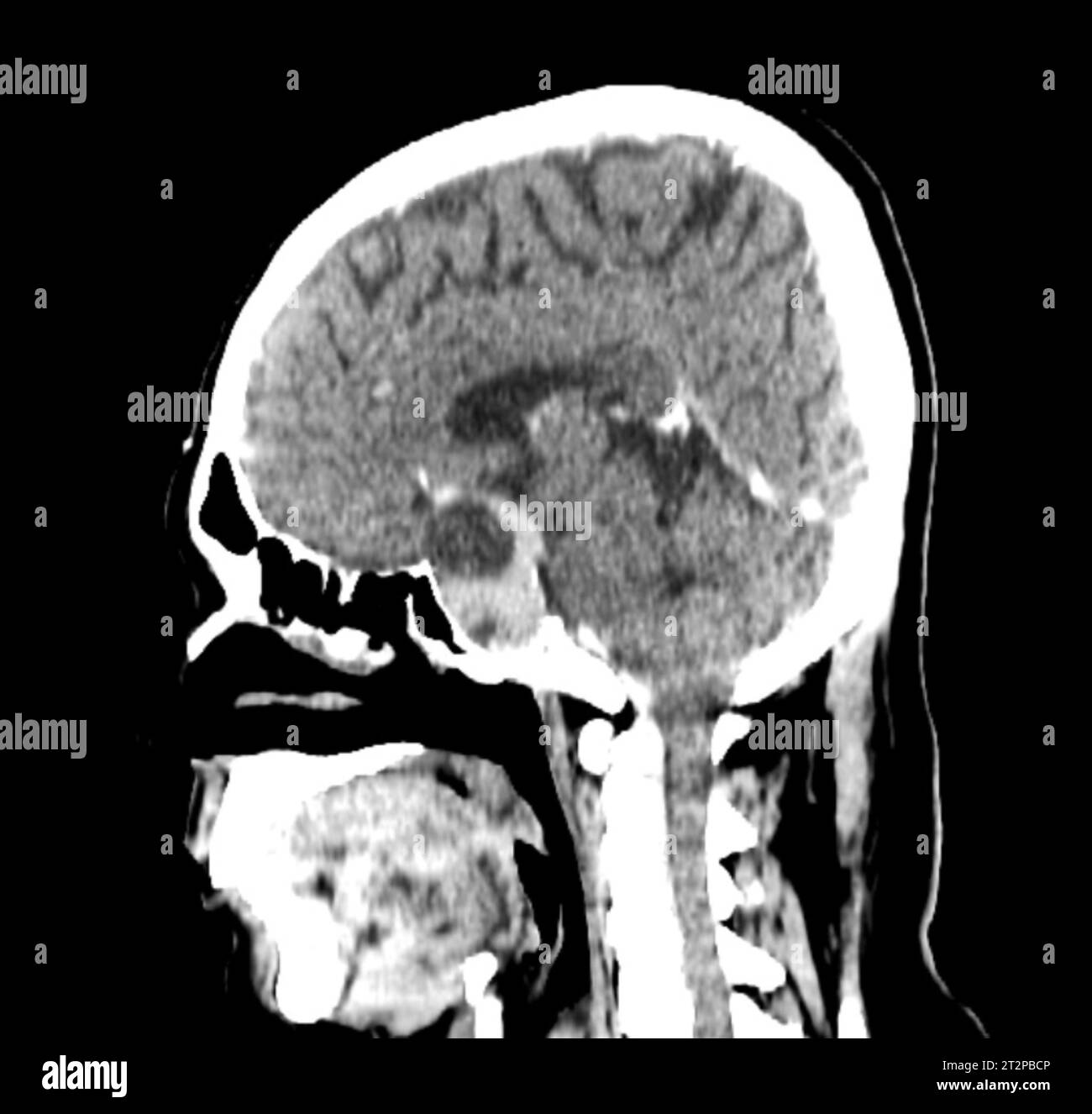 Sellar mass, CT scan Stock Photo