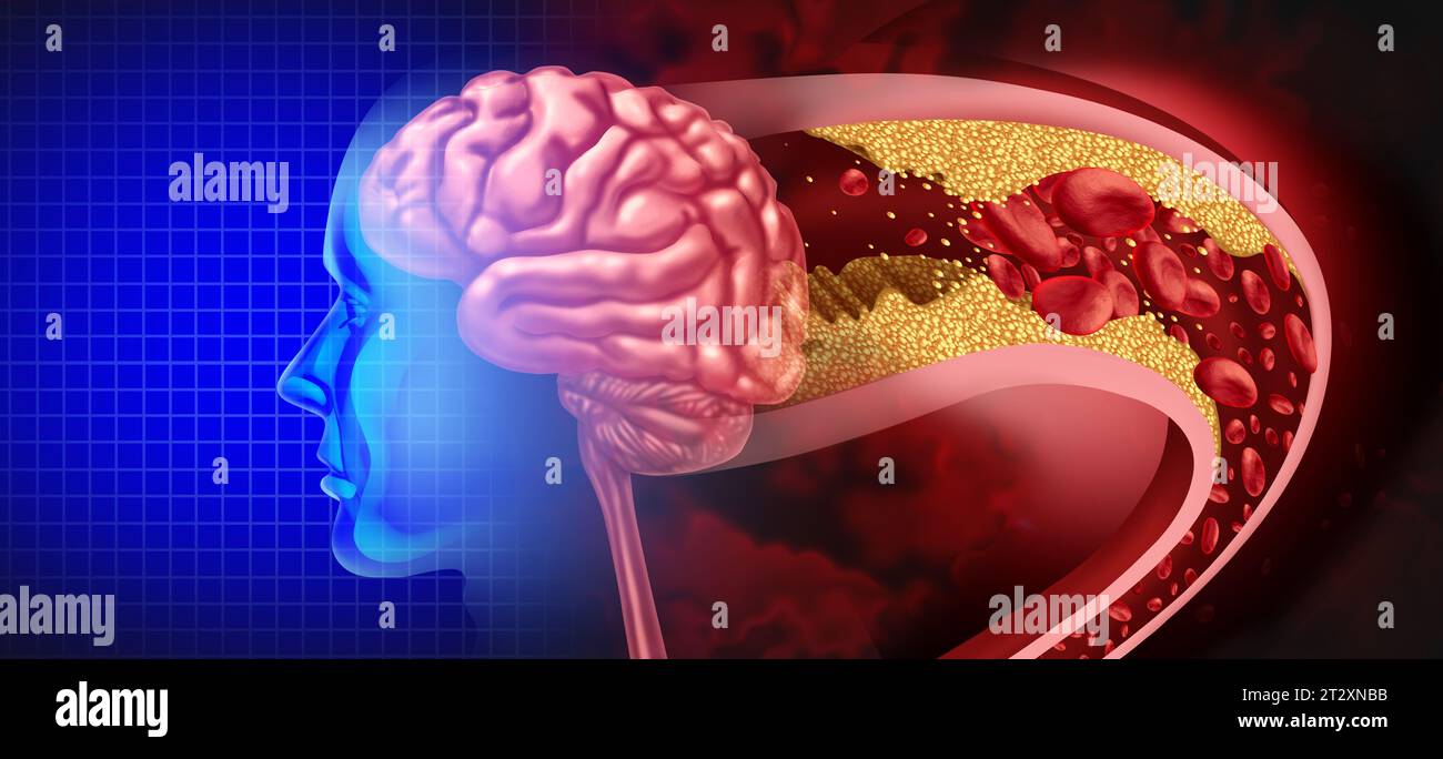Brain Stroke Attack as a Cerebral arteriosclerosis disease as a blocked artery due to plaque