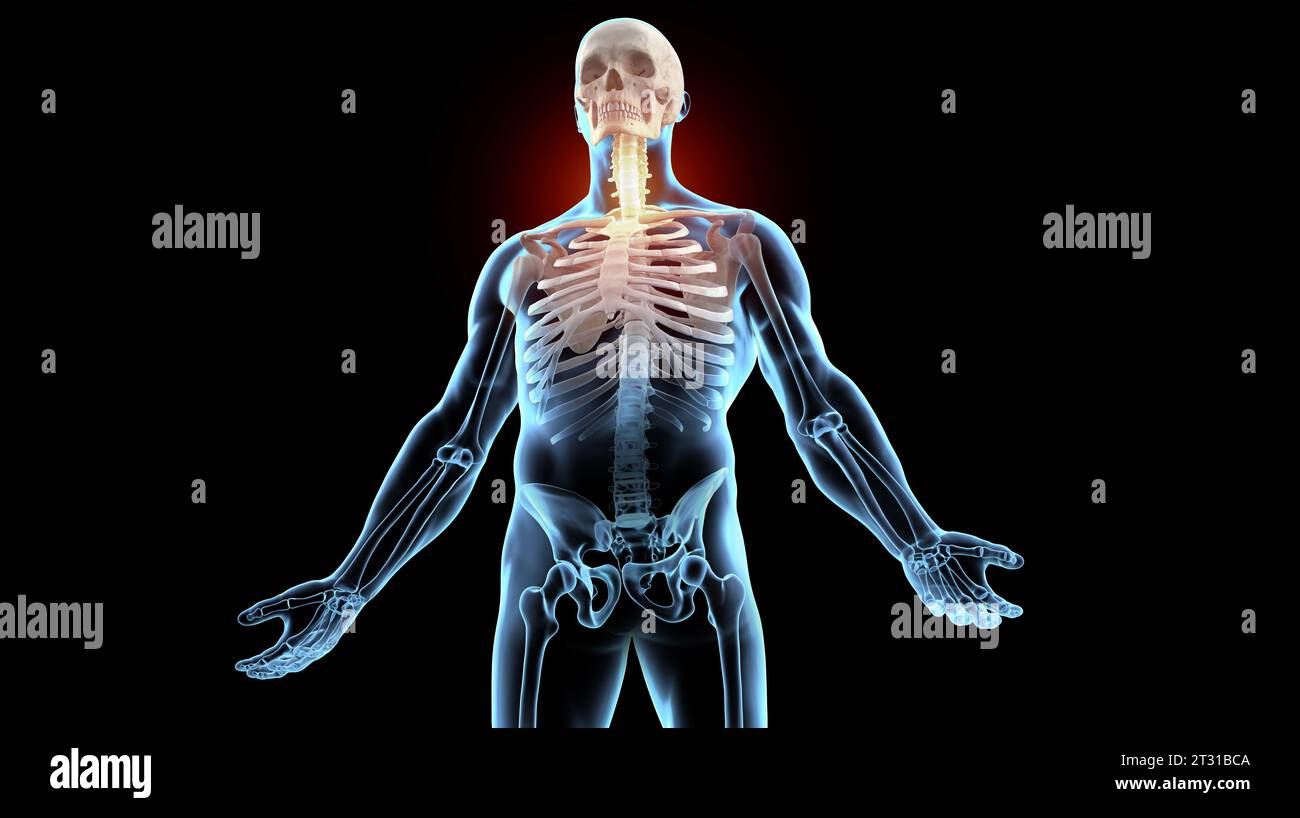 xray skeleton with chest and neck pain Stock Photo Alamy