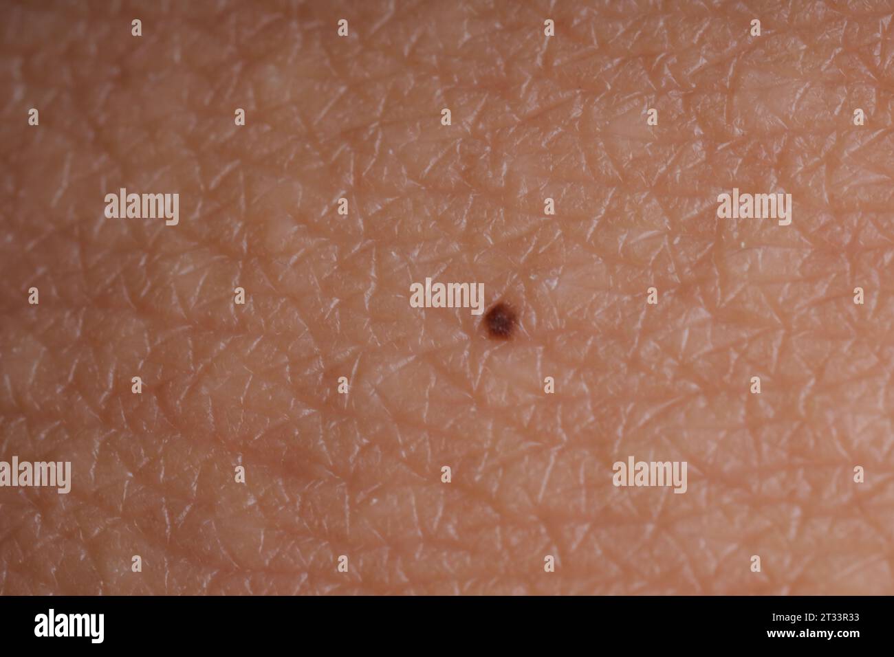 Texture of skin with birthmark as background, macro view Stock Photo ...