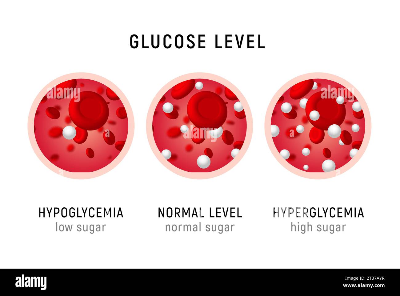 Glucose blood level sugar test. Diabetes insulin hypoglycemia or