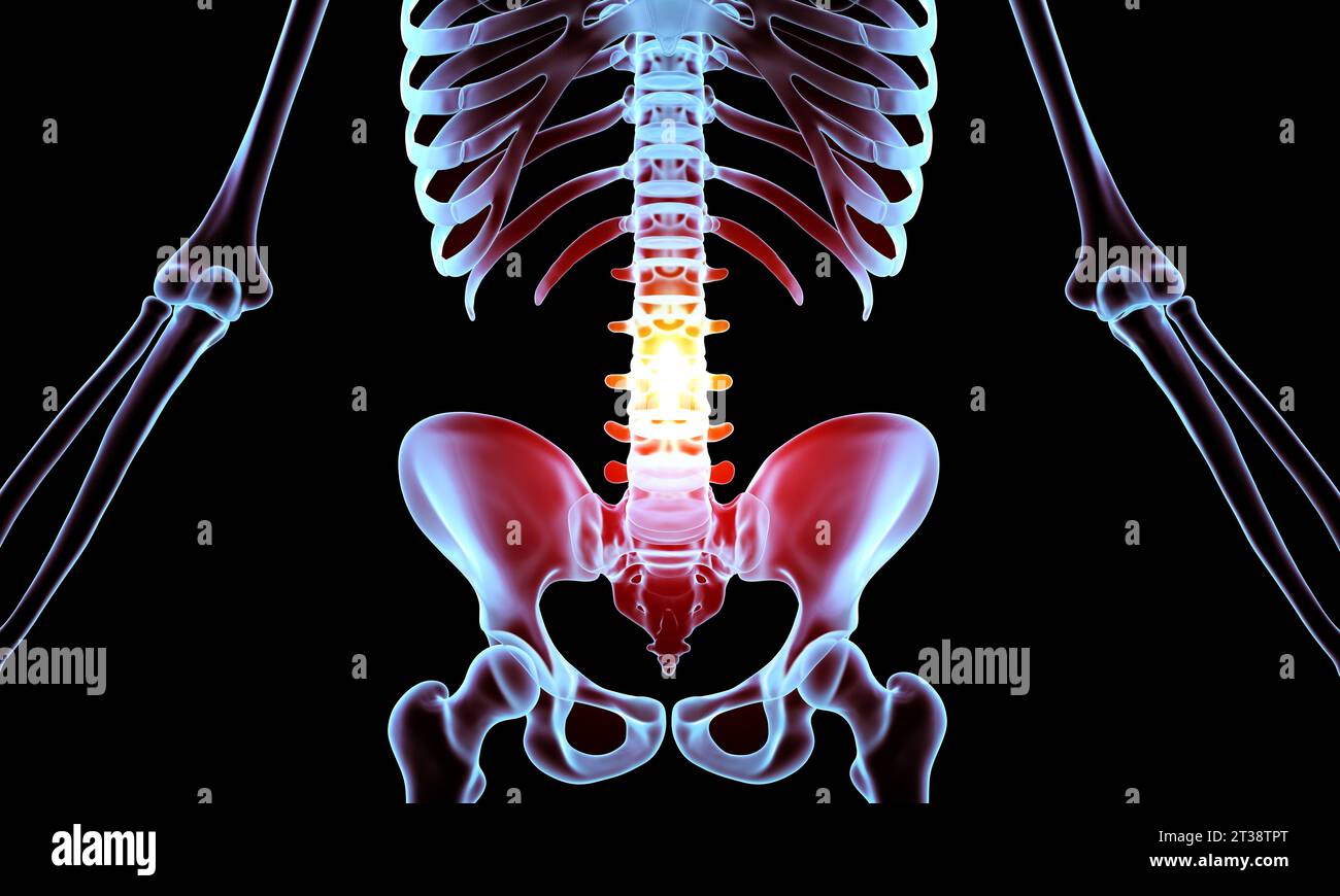 Lumbar spine compression fracture with chronic pain injury Stock Photo