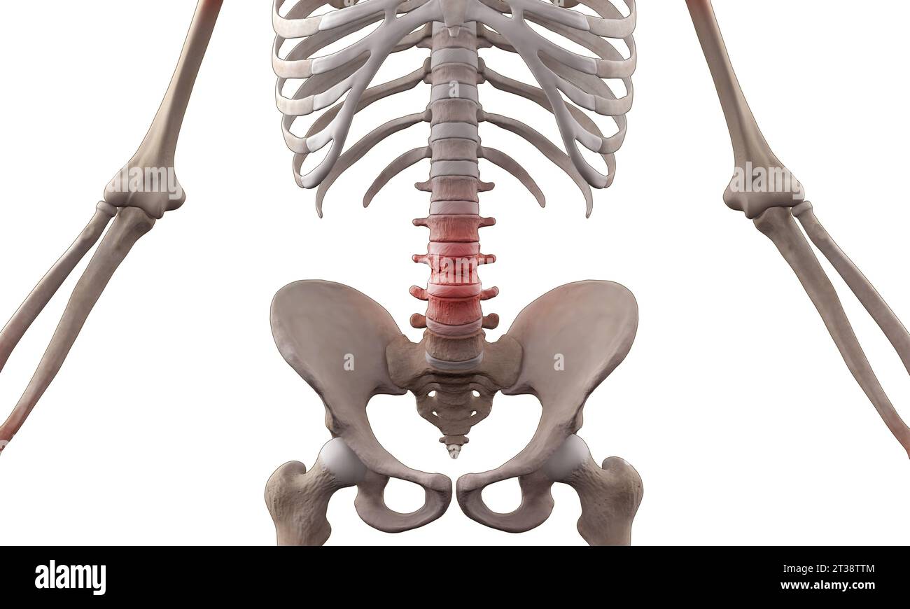 Lumbar spine compression fracture with chronic pain injury Stock Photo