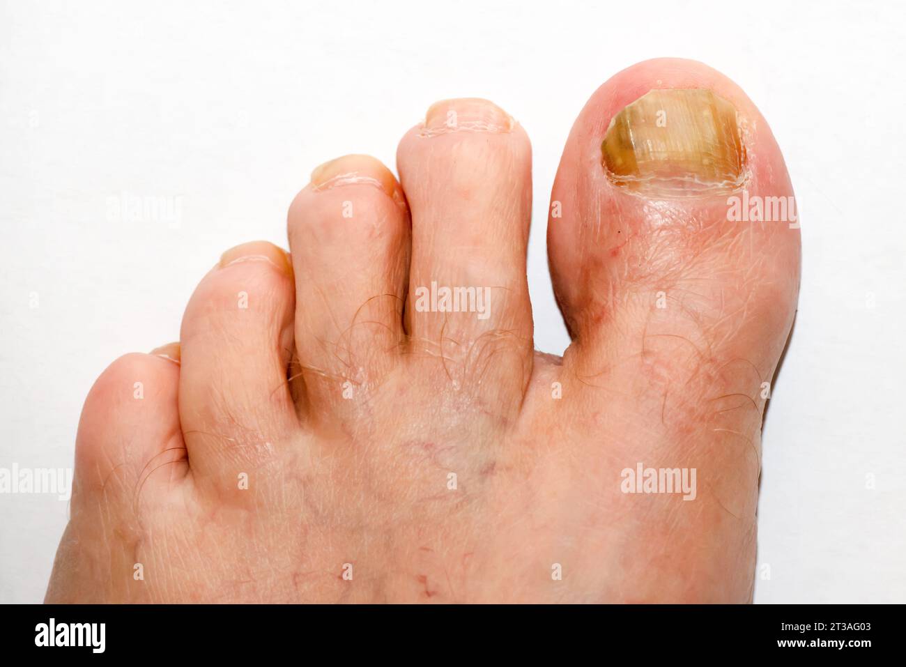 City of Brighton & Hove, East Sussex, UK. Fungal infected toes. 24th October 2023. David Smith/Alamy News Stock Photo