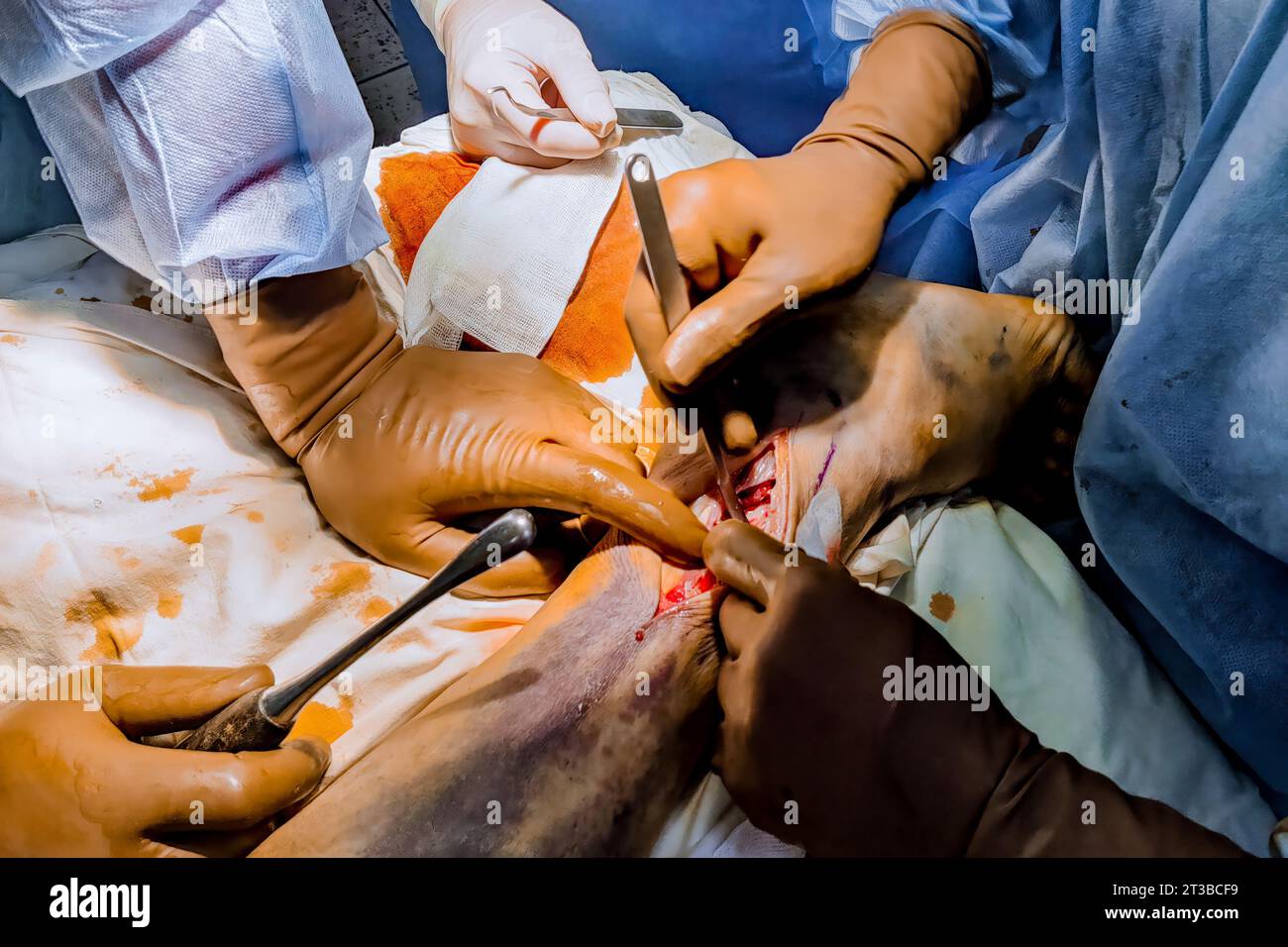 Following leg fracture, metal plate is inserted during surgery by doctors. Stock Photo