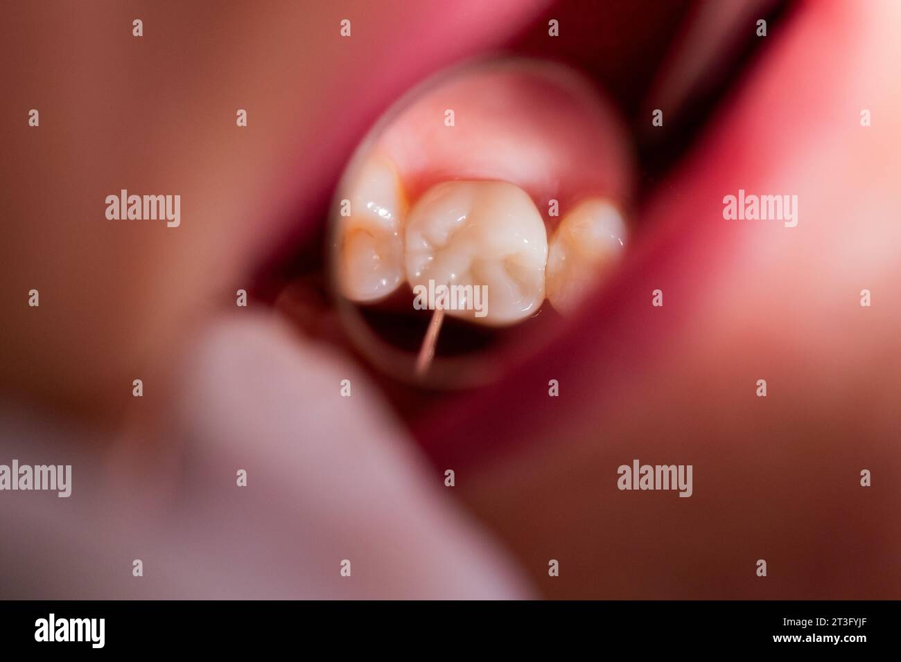 23 October 2023, North RhineWestphalia, Mönchengladbach Dentist Dr. Kranz uses a mirror to