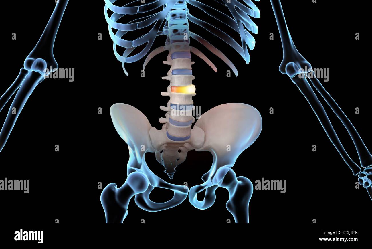 Bulging disc spinal injury skeleton medical illustration Stock Photo