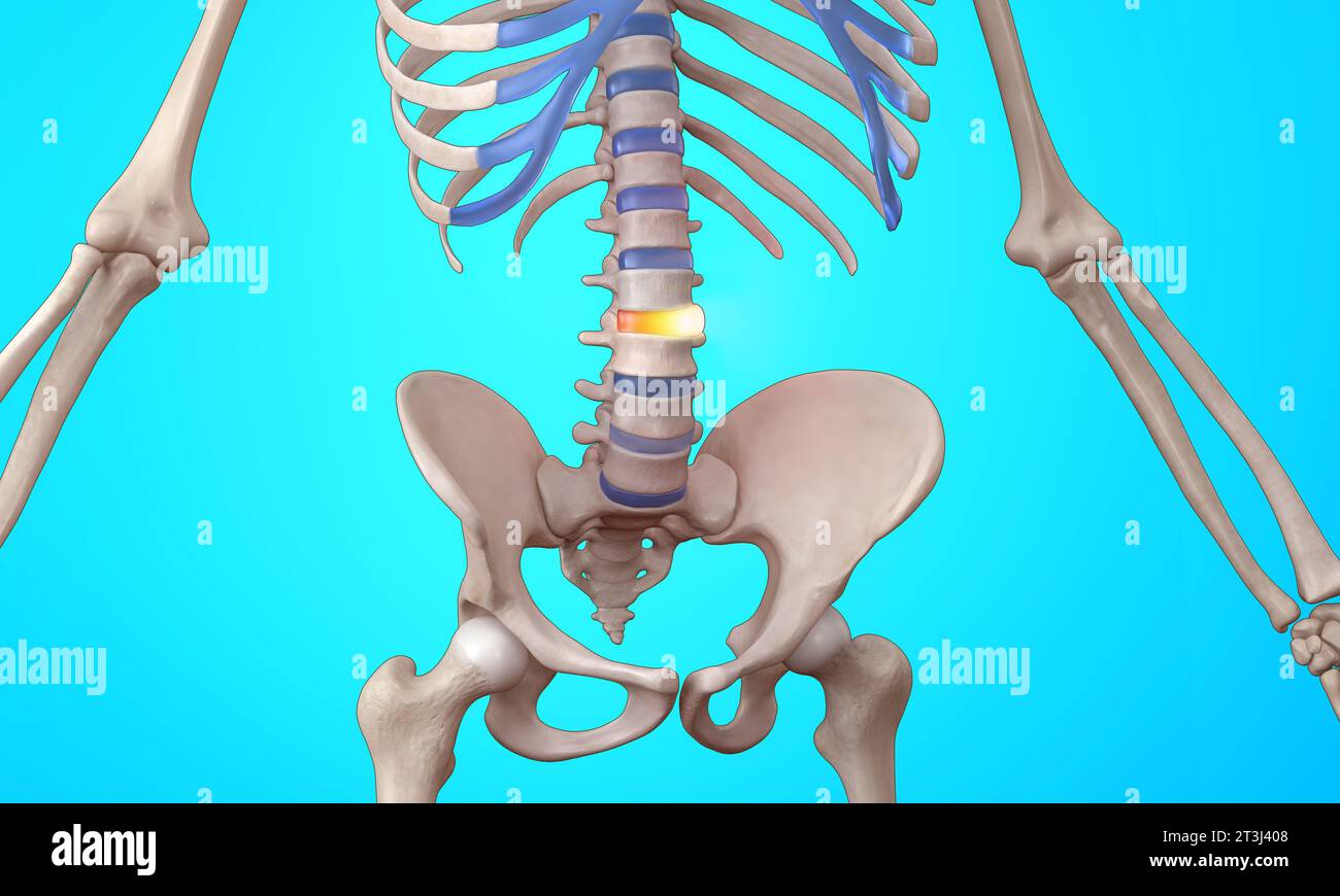 Bulging disc spinal injury skeleton medical illustration Stock Photo