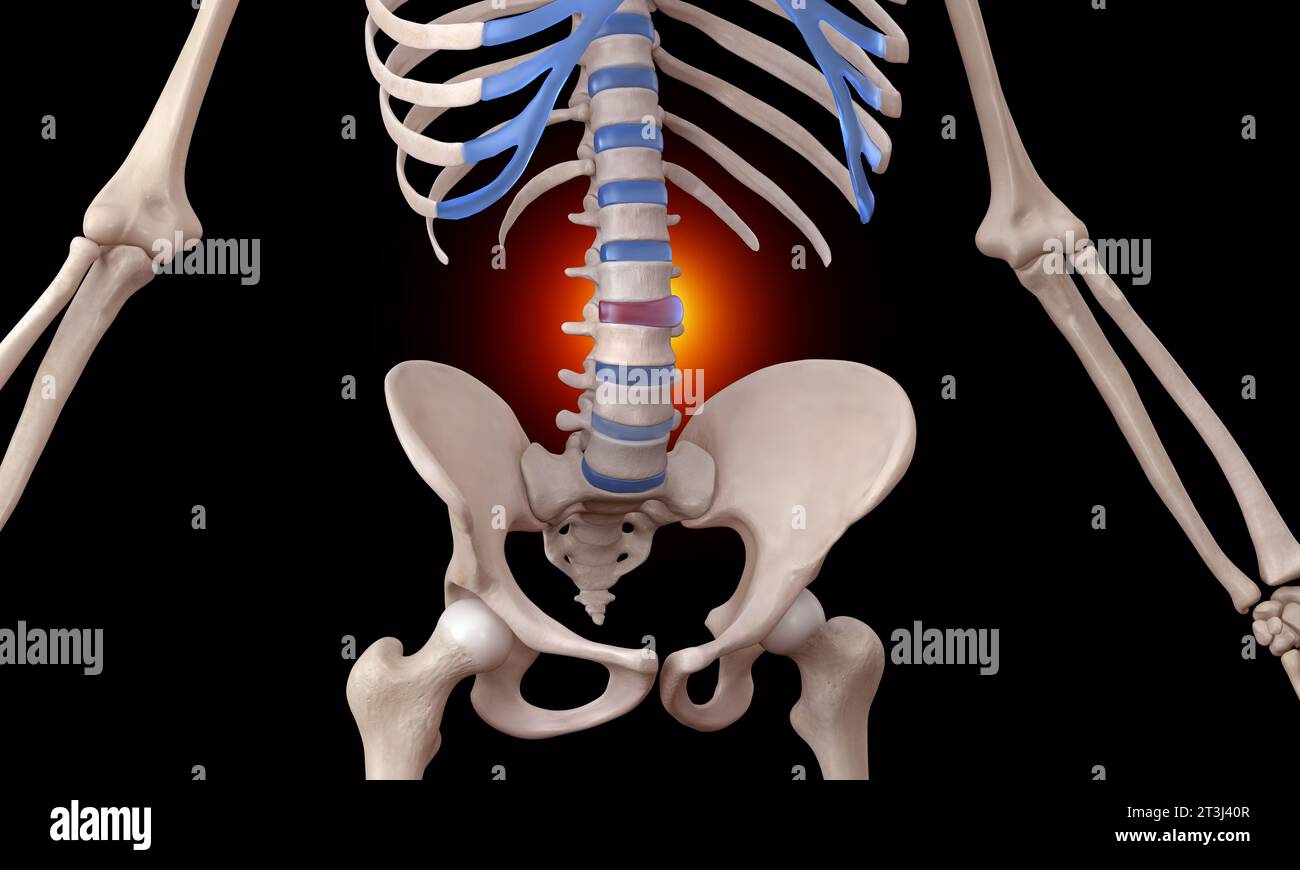 Bulging disc spinal injury skeleton medical illustration Stock Photo