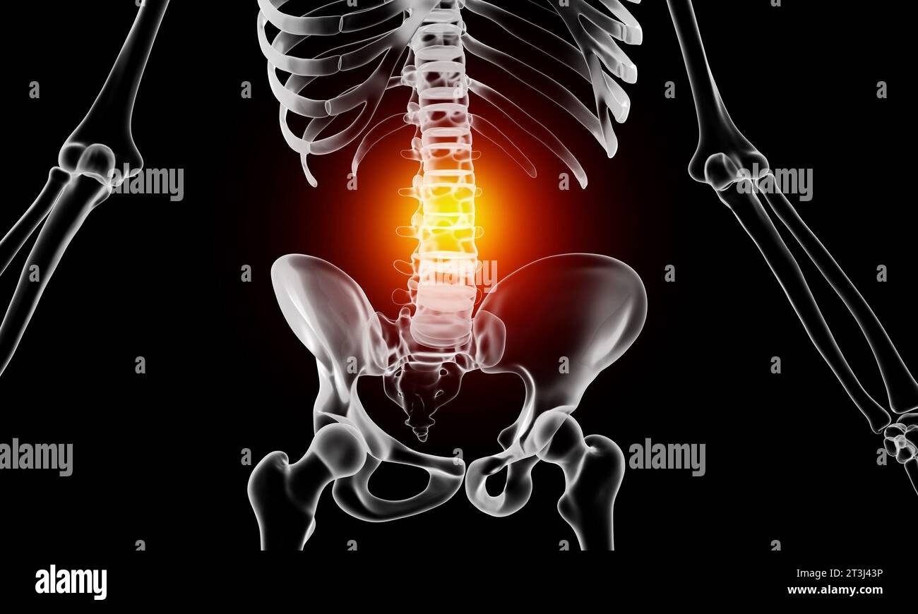 Bulging disc spinal injury skeleton medical illustration Stock Photo