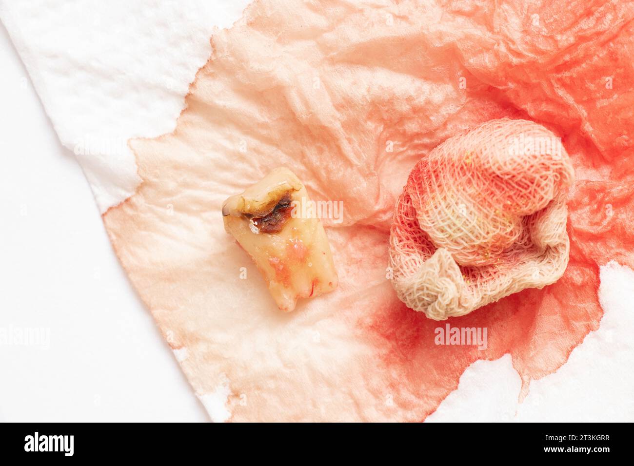 An extracted tooth with a black hole in the middle of the tooth, close-up against the background of a bandage with blood, a sick tooth after extractio Stock Photo