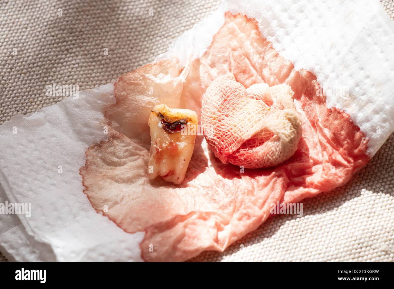 An extracted tooth with a black hole in the middle of the tooth, close-up against the background of a bandage with blood, a sick tooth after extractio Stock Photo