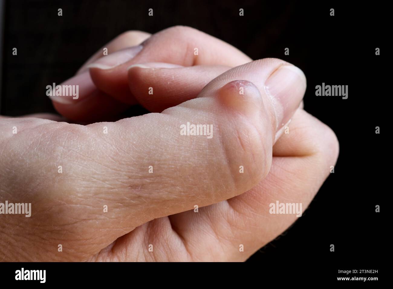 Ganglion cyst (synovial cyst disease) on the thumb of a woman’s hand