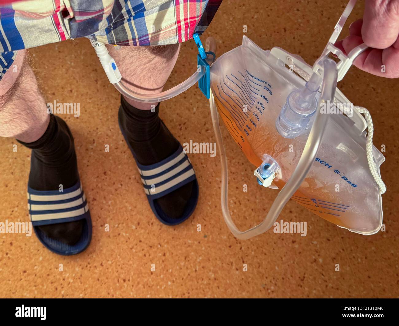 Mann im Krankenhaus, nach einer urologischen Operation, mit Urinbeutel an einem Blasenkatheter