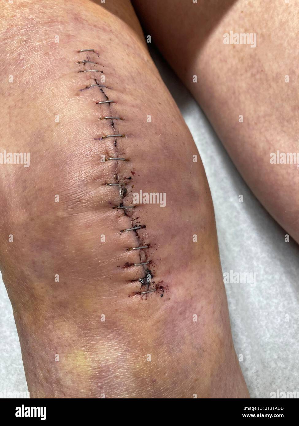 Close-up view of woman with large scar on knee after surgery Stock Photo