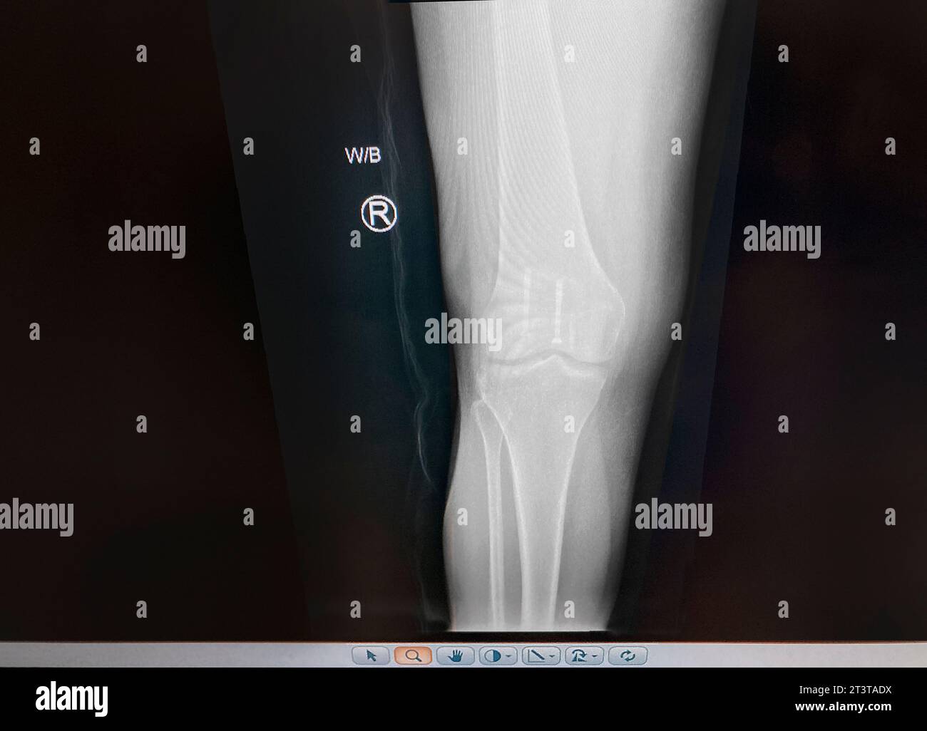 Medical x-ray of mid-adult woman's repaired patella Stock Photo