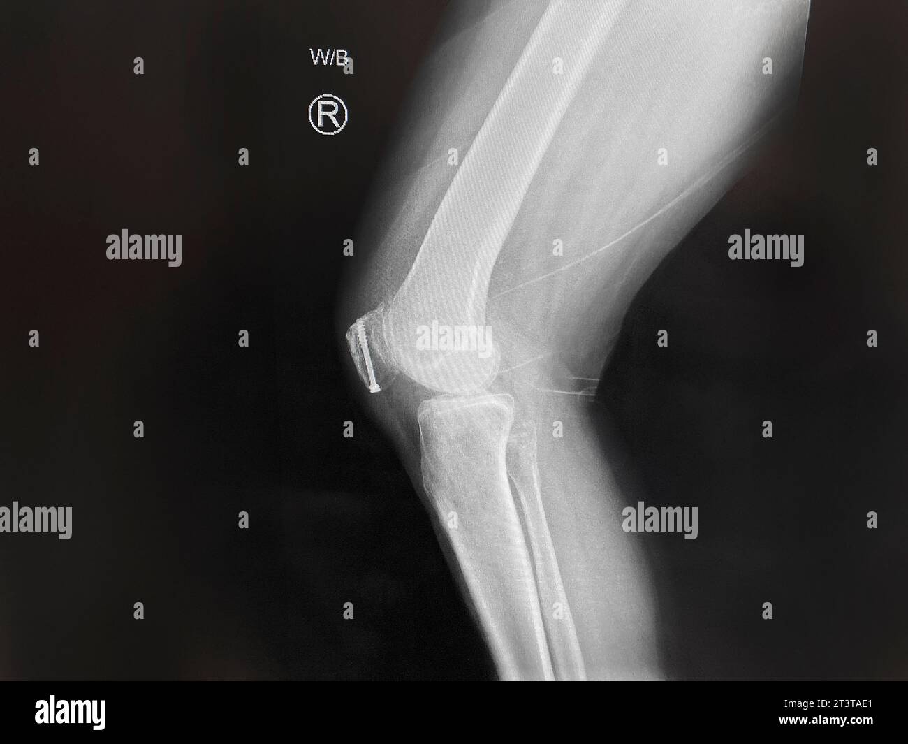 Medical x-ray of mid-adult woman's repaired patella Stock Photo