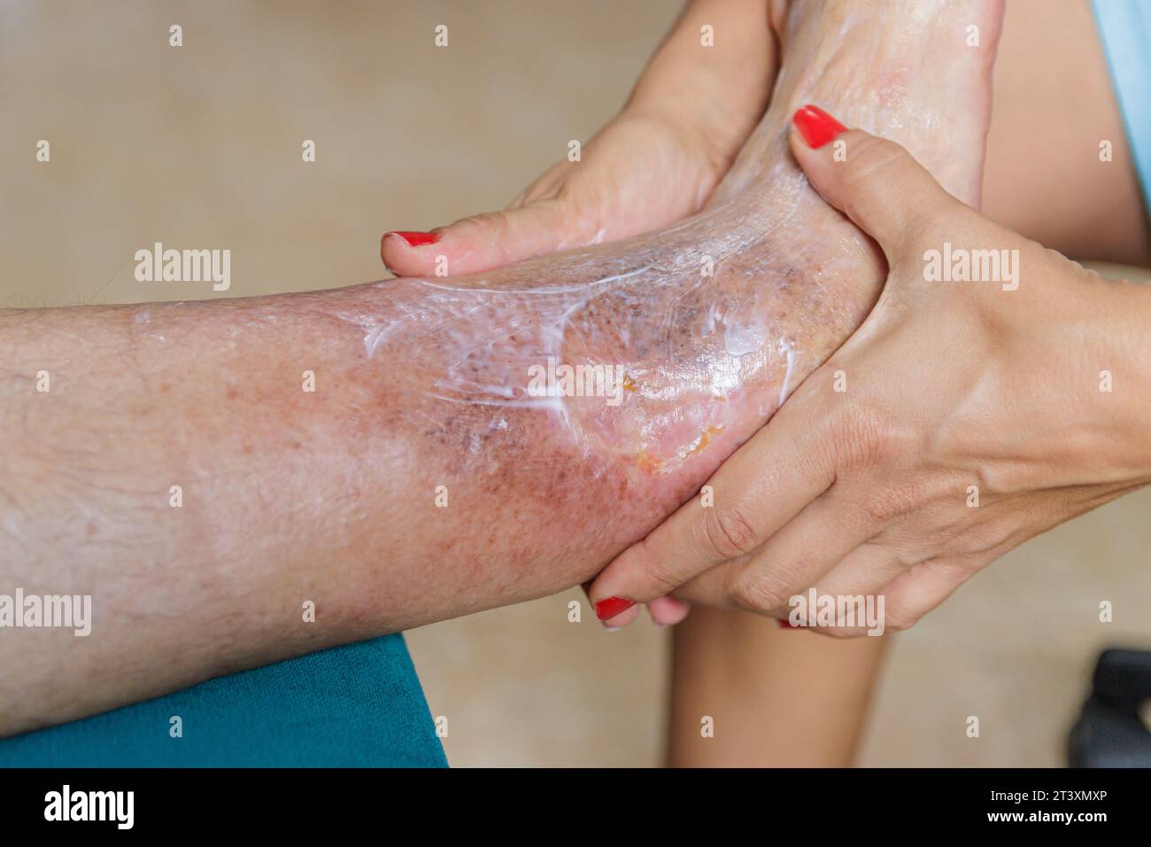 Home health care for an elderly person. Leg with ulcer due to diabetes. Stock Photo