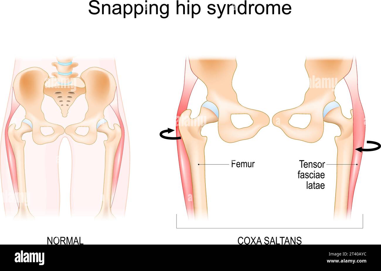 Snapping hip syndrome. Coxa saltans.  iliopsoas tendinitis. dancer's hip. Anatomy of a Human Hip. Vector illustration Stock Vector