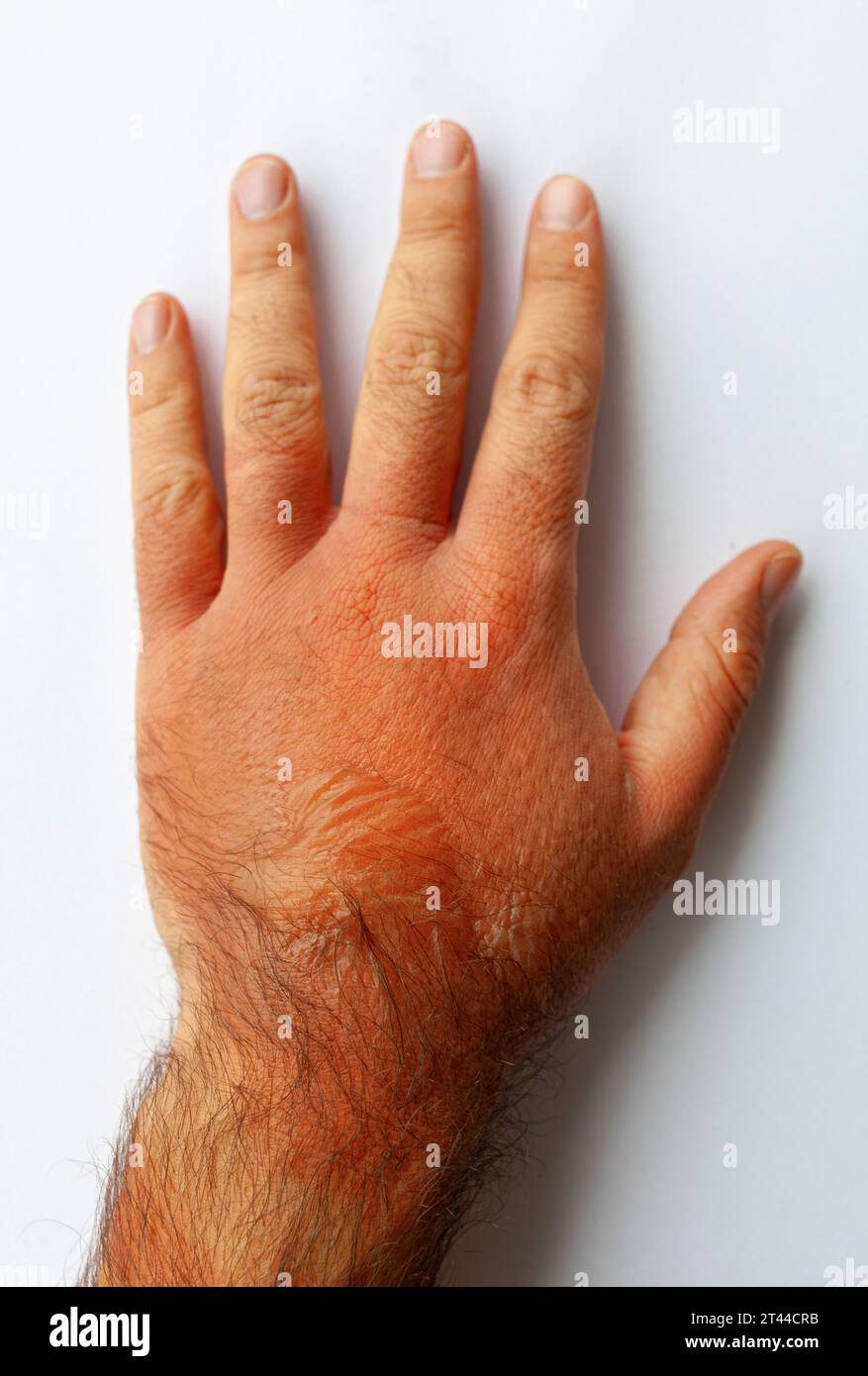 A man's hand burned with boiling water. On it there are redness and