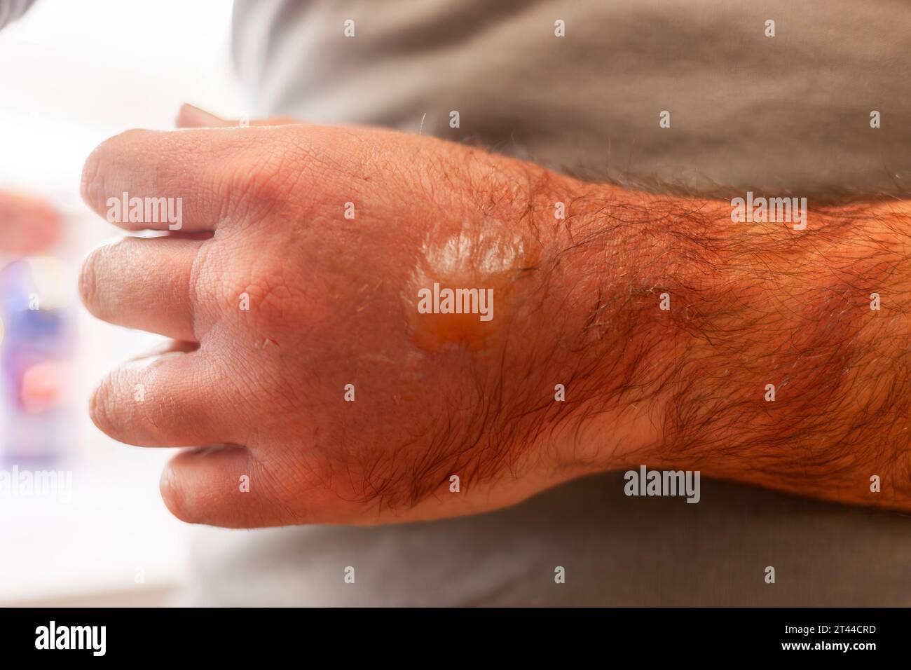 A man's hand burned with boiling water. On it there are redness and