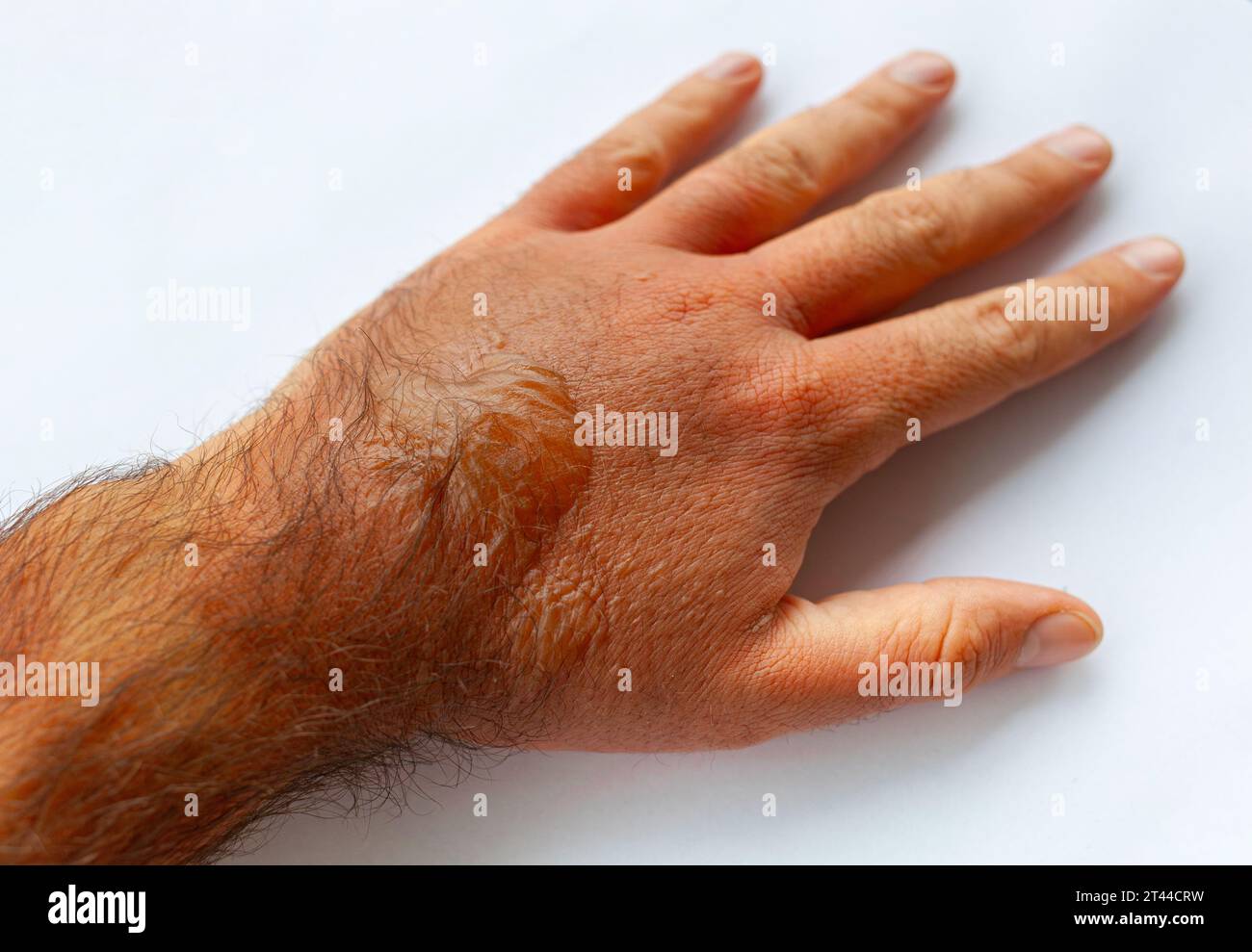 A man's hand burned with boiling water. On it there are redness and