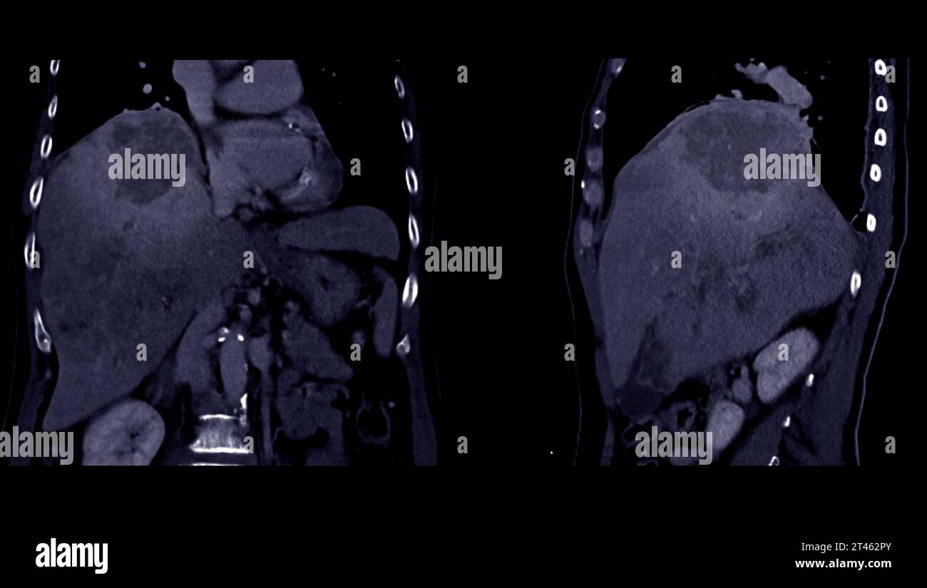 CT upper abdomen coronal and sagittal view showing DDX is atypical HCC ...