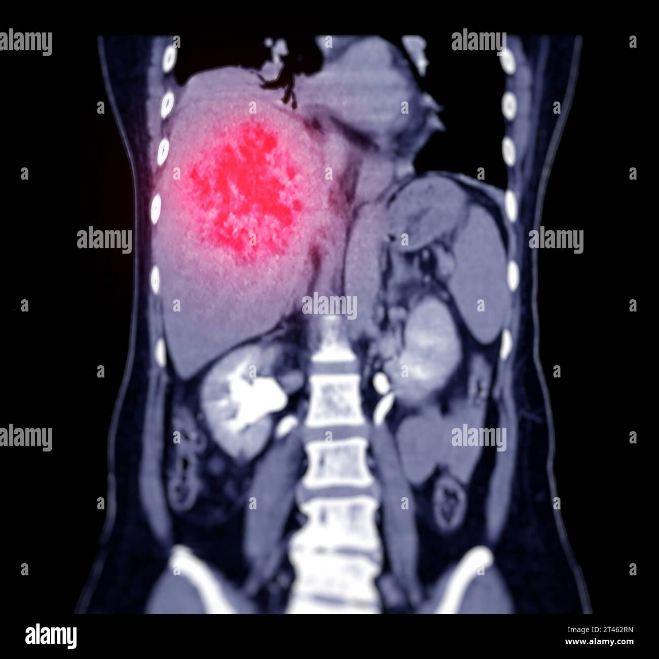 CT upper abdomen coronal view showing DDX is atypical HCC or ...