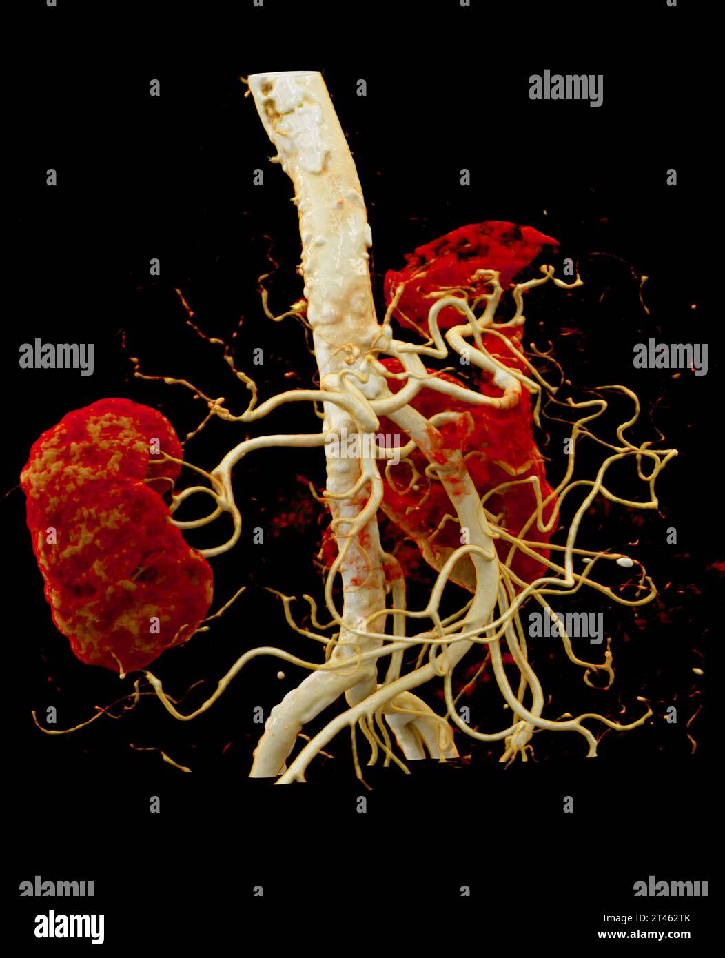 CTA Renal artery is a medical imaging procedure using CT scans to examine the renal arteries It provides detailed images of the blood vessels supplyin Stock Photo