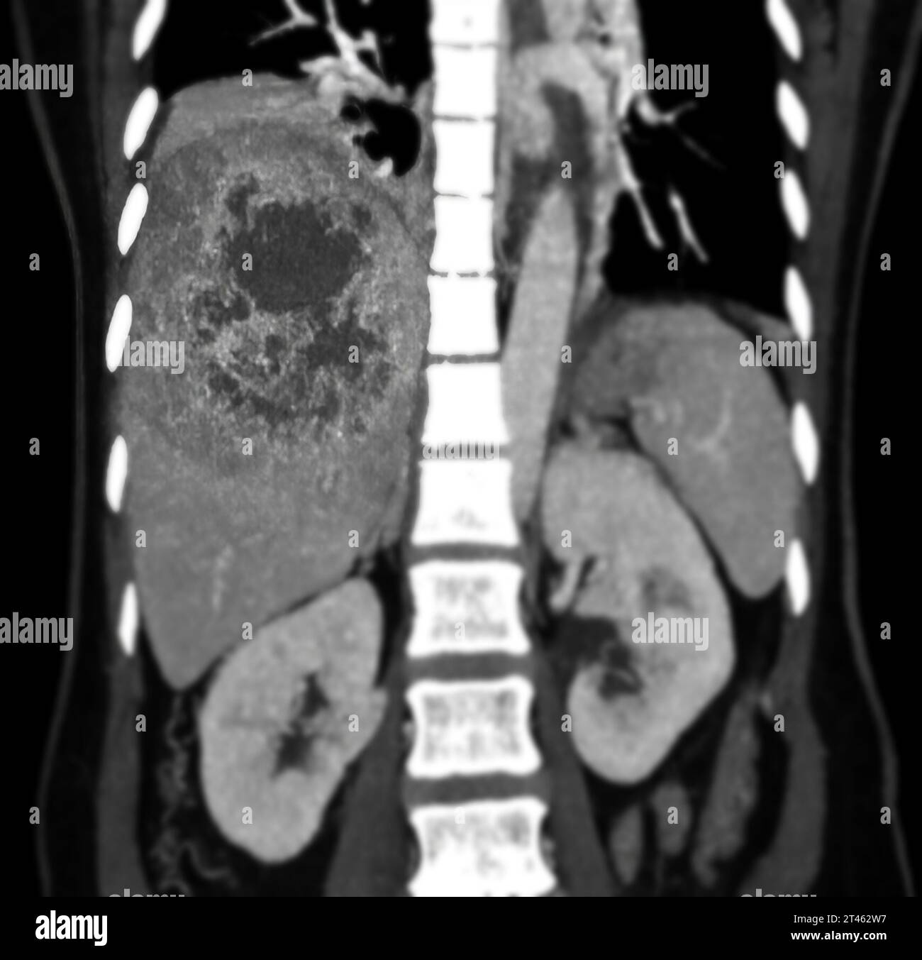 CT upper abdomen coronal view showing DDX is atypical HCC or