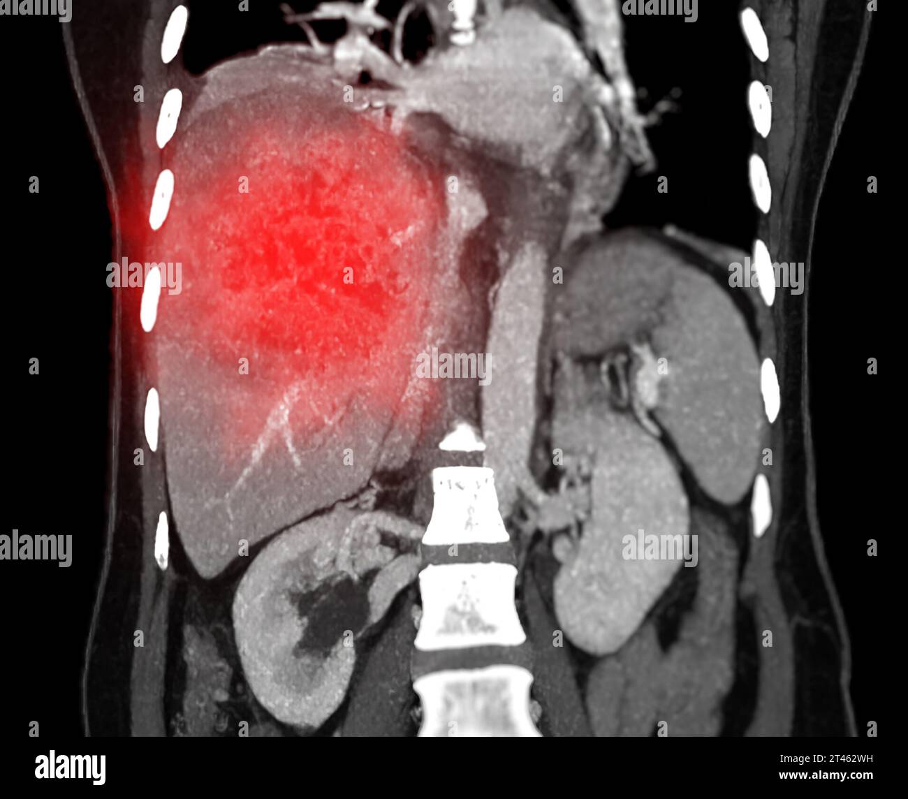 CT upper abdomen coronal view showing DDX is atypical HCC or ...