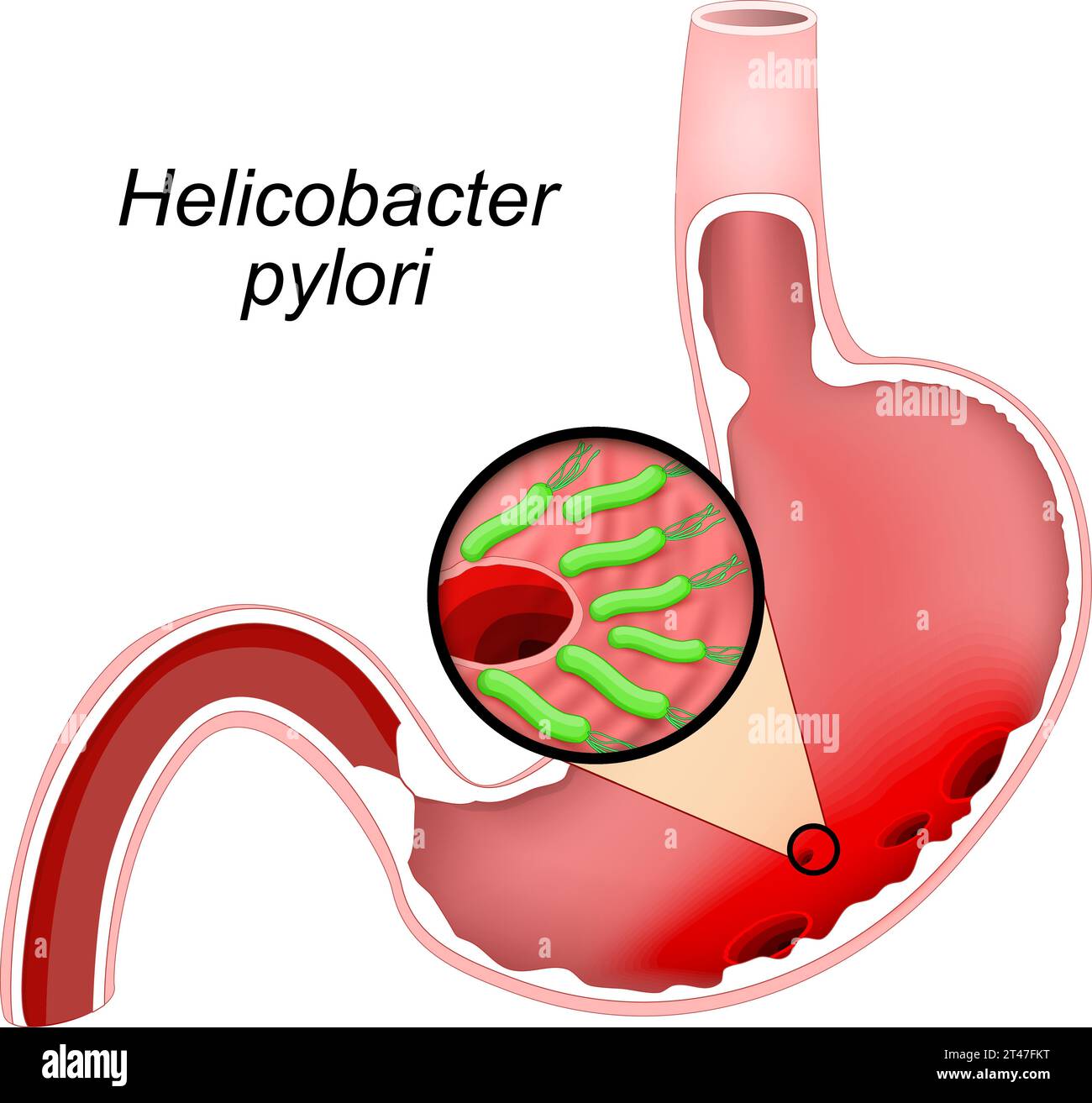 Cross section of a human Stomach with ulcers. Close-up of bacteria Helicobacter pylori that caused Gastric ulcers. Peptic ulcers. Vector illustration Stock Vector
