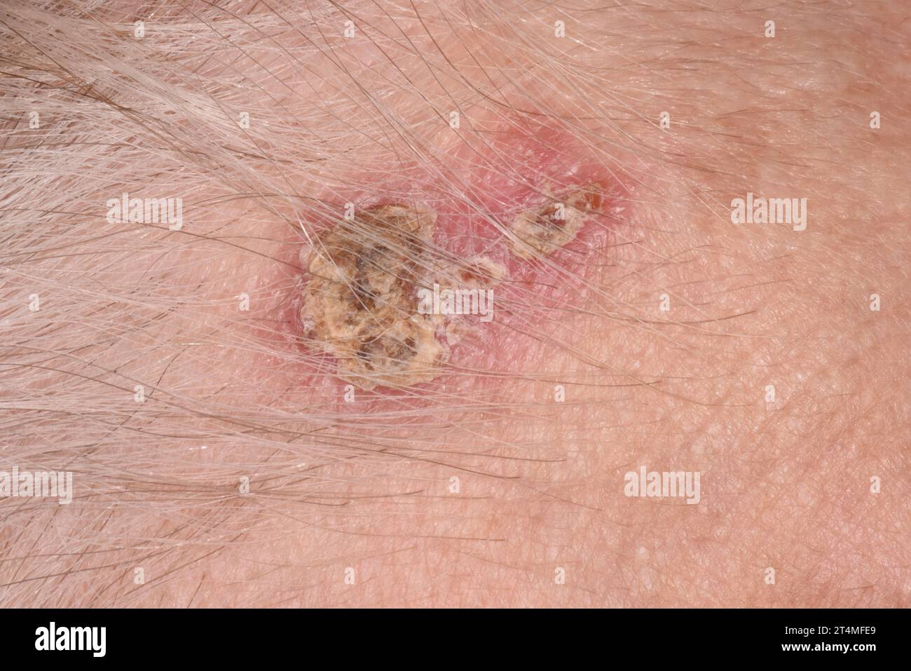 Basal cell carcinoma on a woman's forehead Stock Photo Alamy