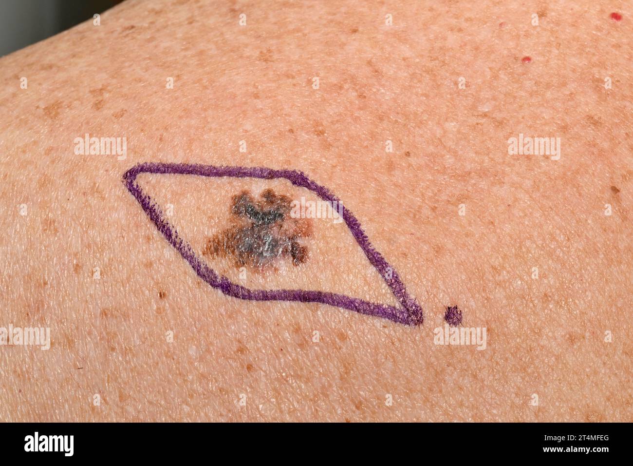 Malignant Melanoma Prior To Excision Stock Photo Alamy malignant-melanoma-prior-to-excision-stock-photo-alamy