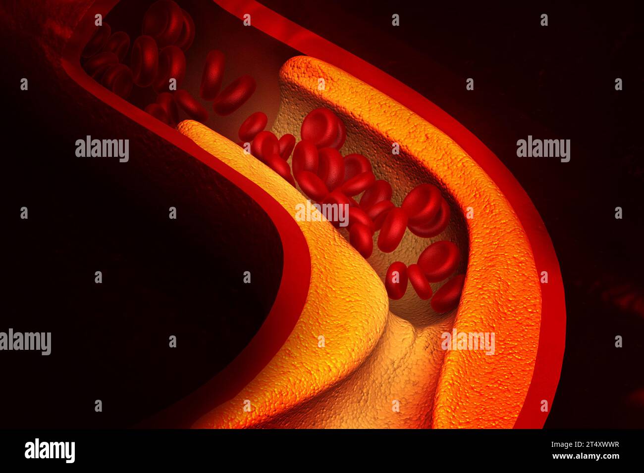 Cholesterol blocking artery. 3d illustration Stock Photo