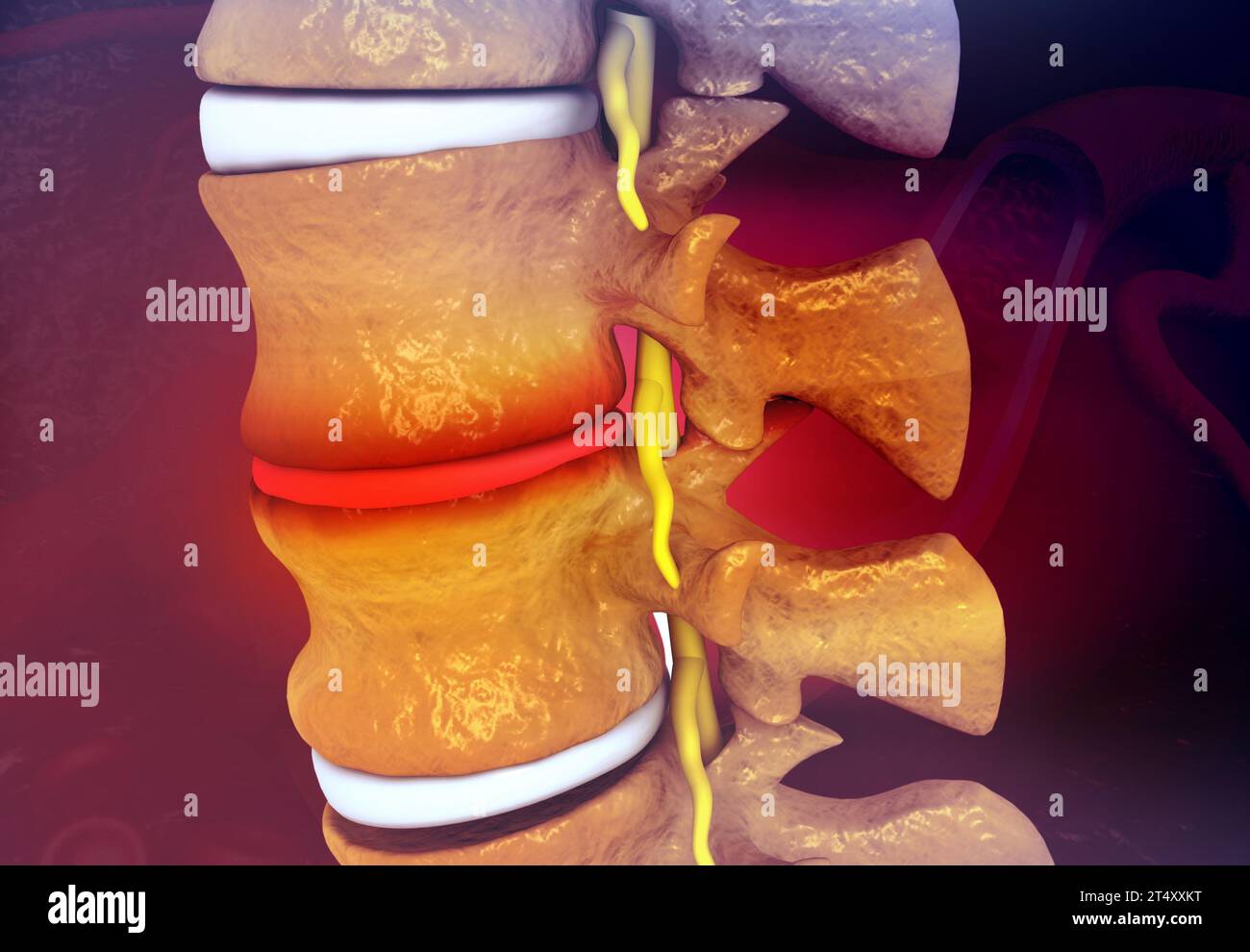 Human Spine With Slipped Disc on medical science background. 3d ...