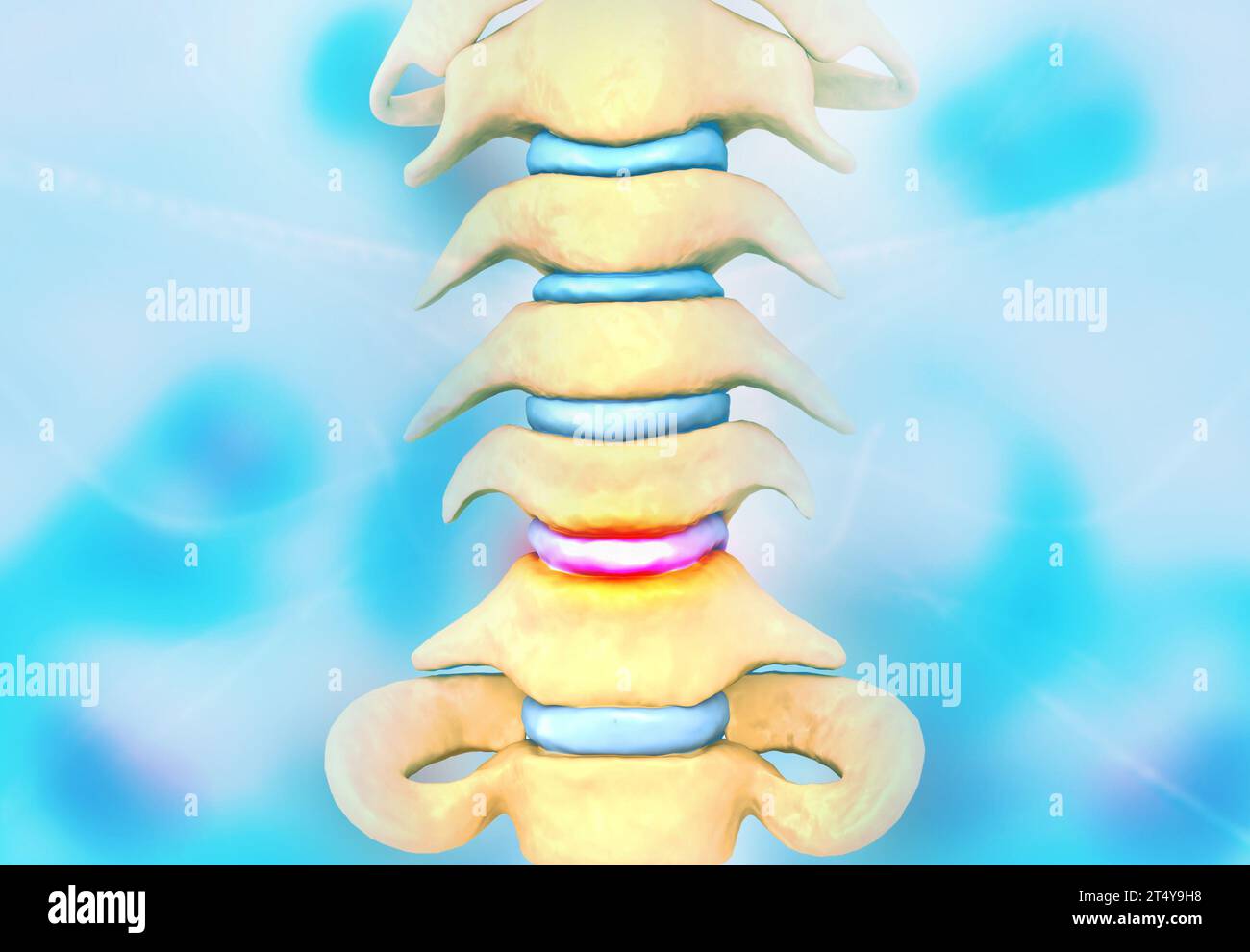 Disc problem of human spine. 3d illustration Stock Photo