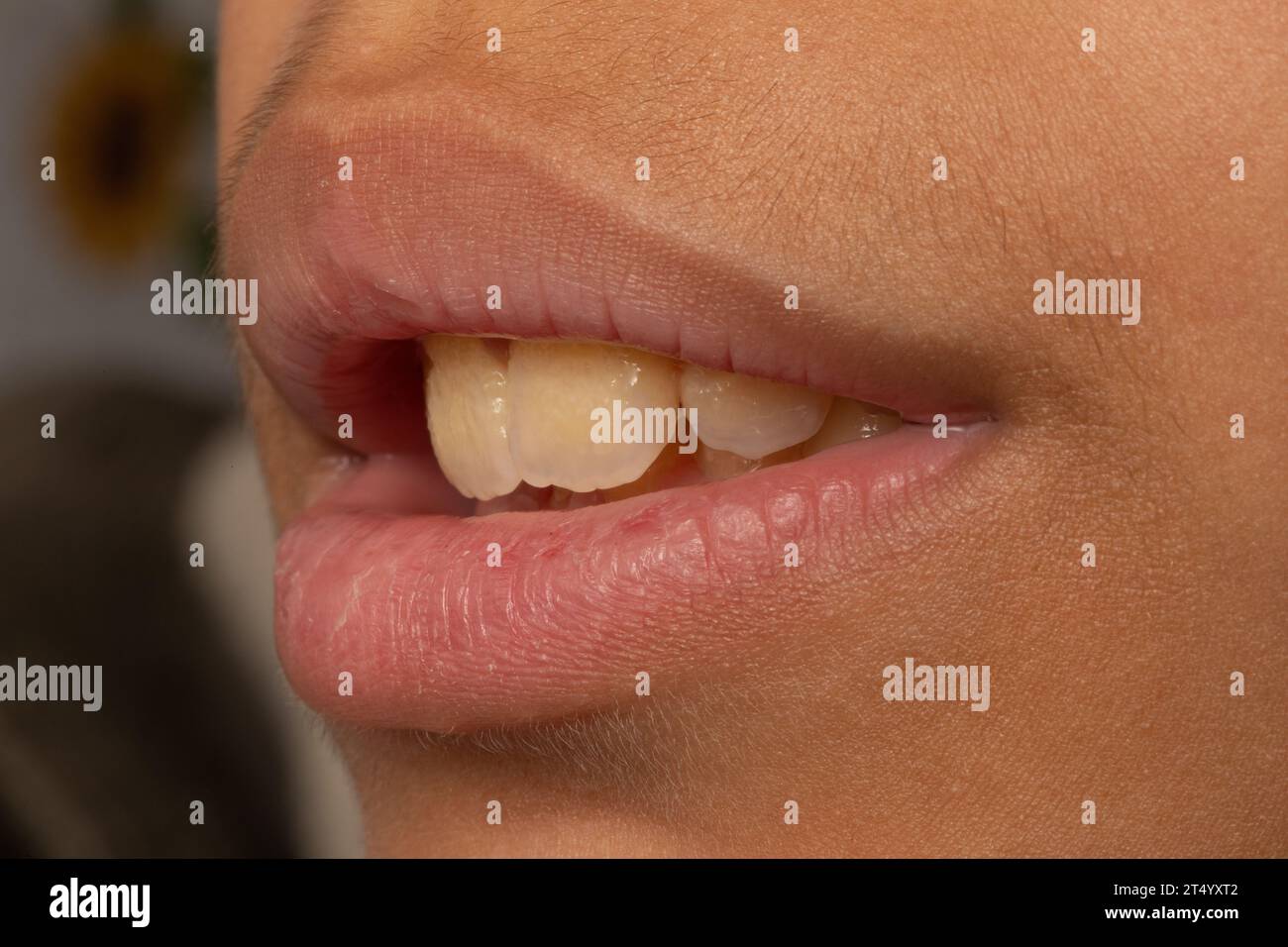 Closeup of a kid's open mouth showing plaque on yellow teeth Stock Photo